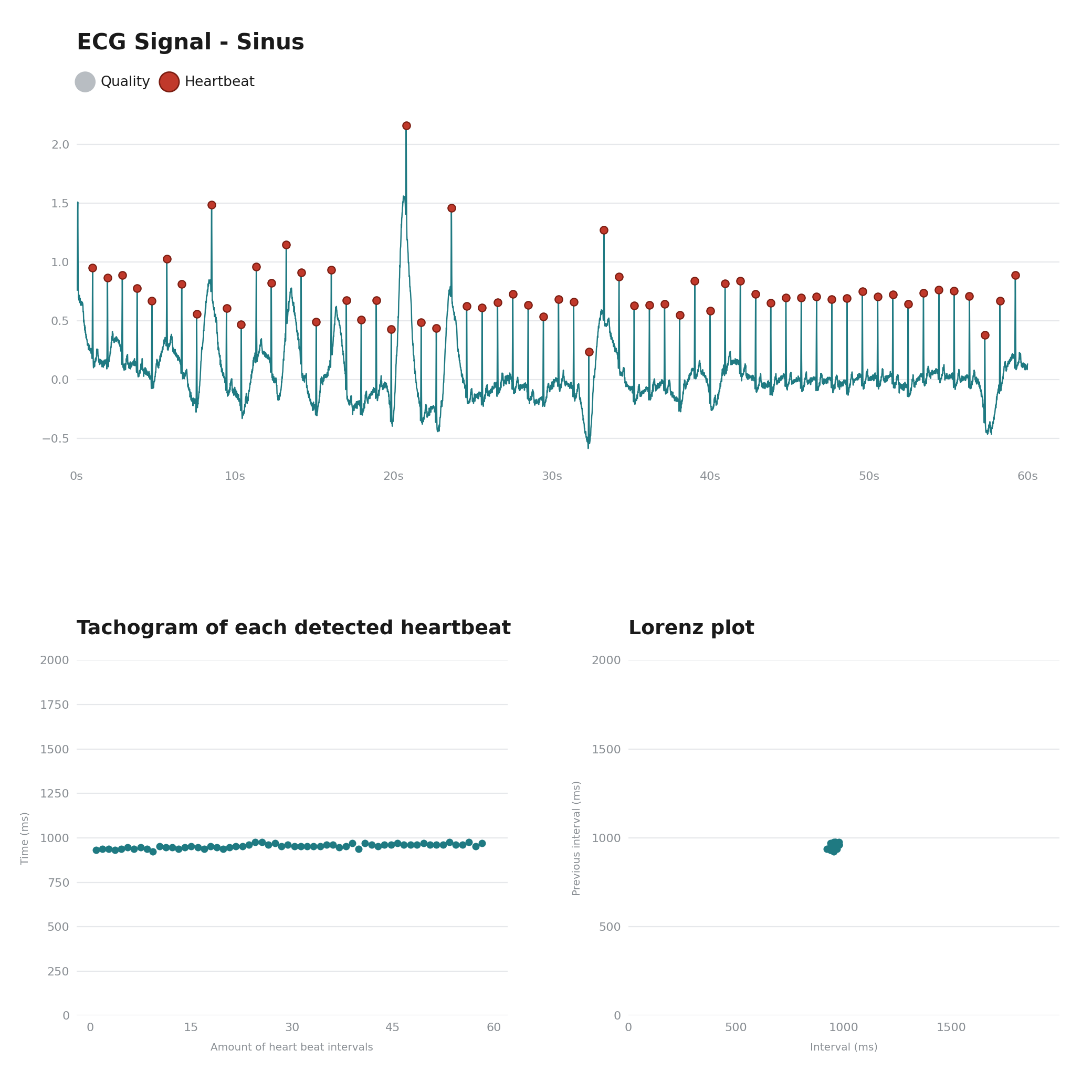 ECG-analyse van een regelmatig sinusritme